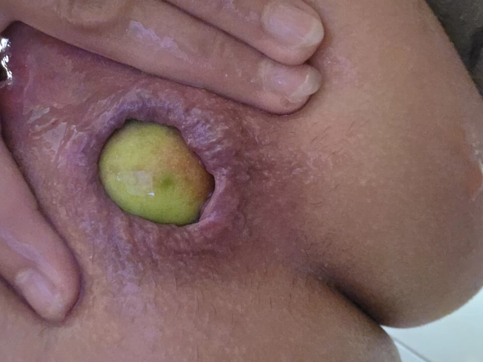 Dilatation anale avec 2 pommes à la maison...