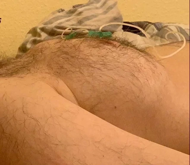 Saline breast