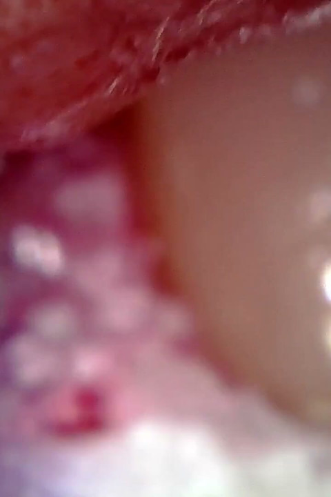 Medical Endoscope Oral Exam: Gummy Chewing, Extreme Teeth & Tongue Macro