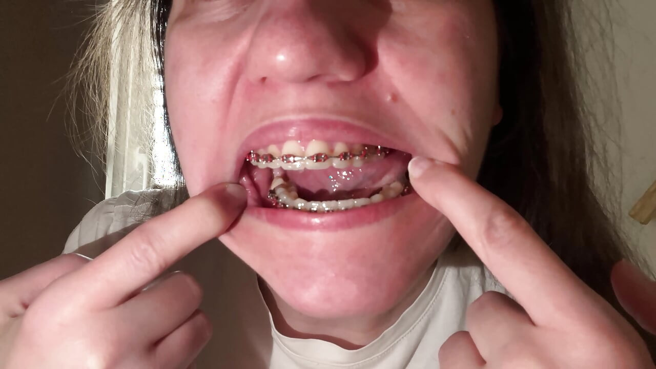 Lamer los brackets con la lengua