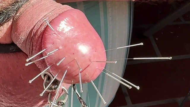 Extreme glans - Acupuncture
