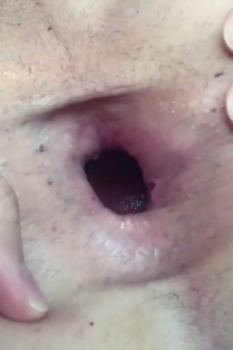 Close Gape Hole