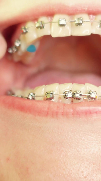 Iconic moment from "eating in braces - vore and food fetish - close up video"