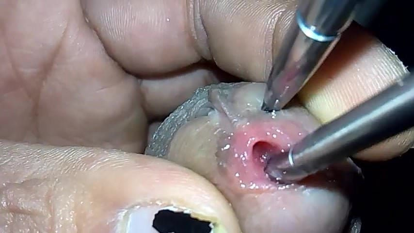 close up insertion 3