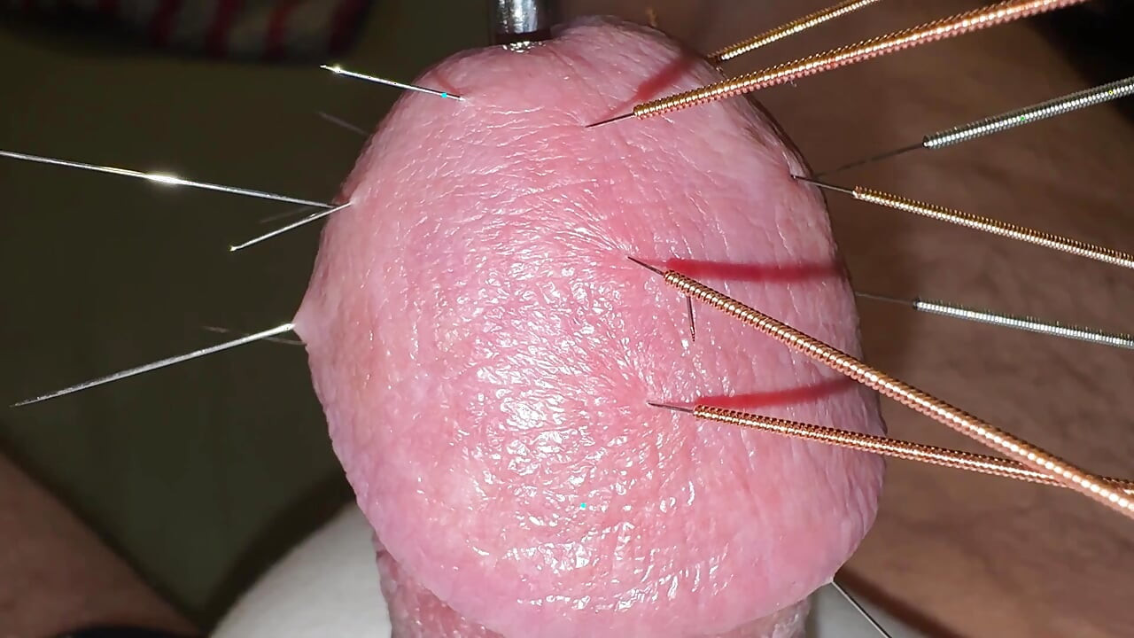 Acupuncture - Orgasm!