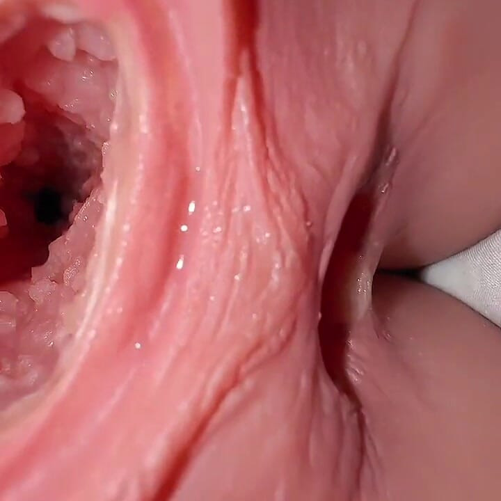 Replacing the Tight Hole with a Tinned One! an Unexpected Turn of Events After the Failure with the Virgintight