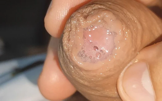Zayıf Fimozda Ön Boşluğun Meraklı Yakın Planı.