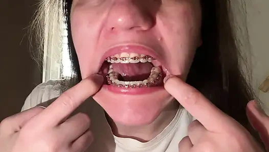 Dilinizle diş teli yalamak