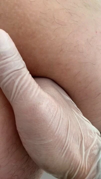 Anal fisting