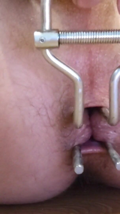 Anal dilator | Clip 1