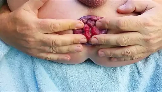 Öz anal fisting benim kirli prolapsusu
