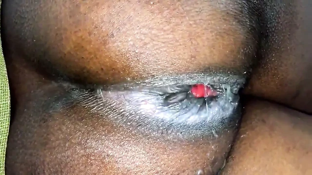 prolapse rectal