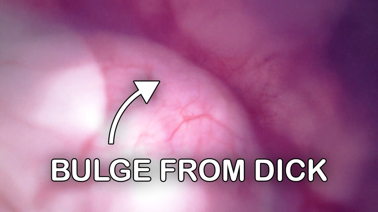 Bulge INSIDE my Bladder from Anal