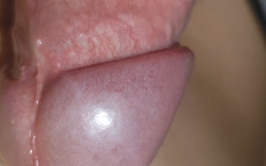 Amazing Upright Rough Venous Frenulum