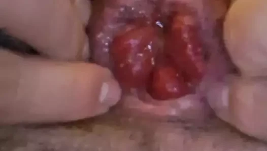 anal prolapsus