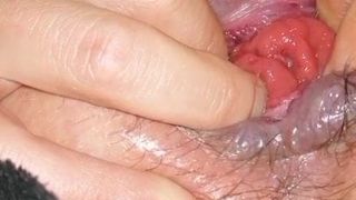Prolapso anal dedilhado
