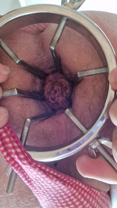 Anal dilation