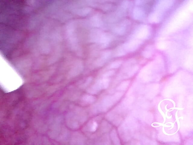 Can I fit the minicam AND a catheter inside my pee hole at the same time?