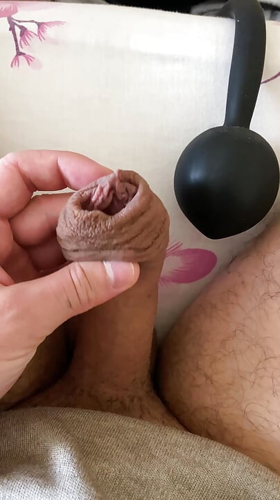 שאיבת עורלה קיצונית