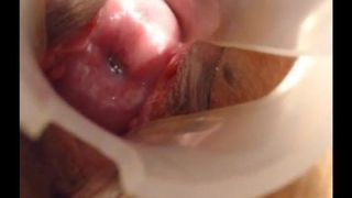 Long cervix show, speculum and try to insert pencil