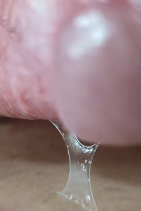 Abrindo a Cicatriz Do Frênulo Áspero!
