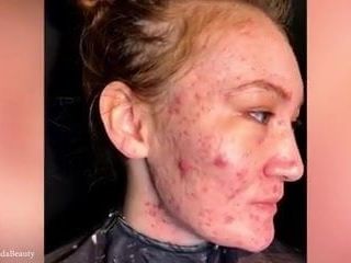 Mulheres com acne muito ruim