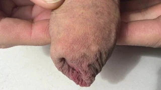 foreskin 1