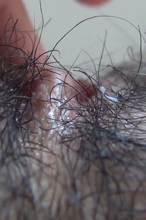 The Mound of the Clitoris