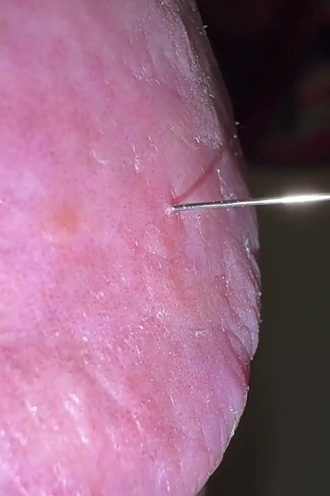 Acorn Acupuncture with Mega Orgasm!