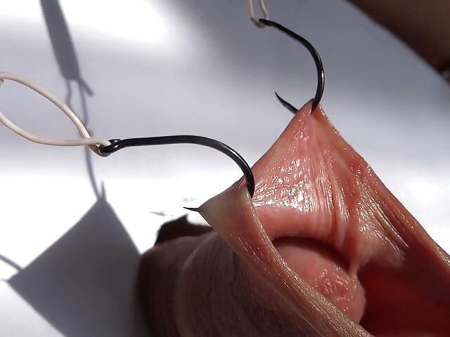 fishhooks in foreskin