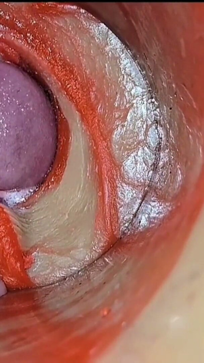 Cumfeti Damlayan Creampie Derlemesi - Endoskopi Görünümü | Bölüm 1