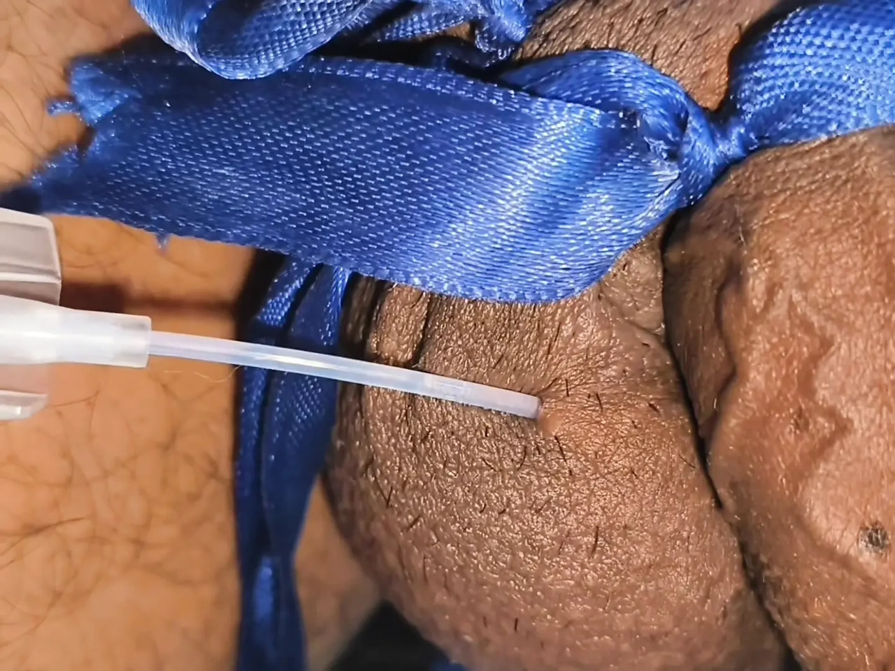 4 Litre Saline Infusion (41445)