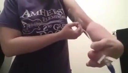 finger amputee