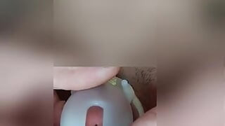 Use dilator despite penis cage