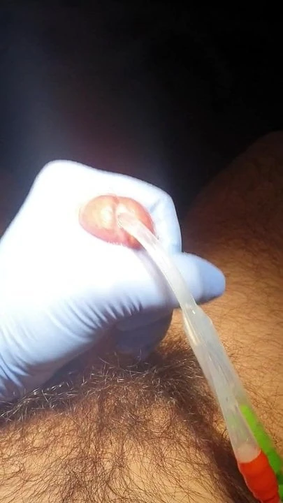 Catheter play with left-handed nurse
