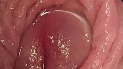 Foreskin close up with alot of piss