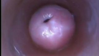 Utérus vaginal et éjaculation intravaginale307