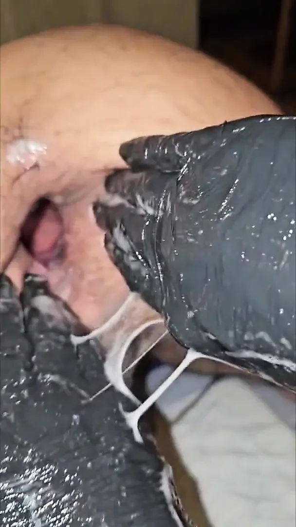 fistlovergr cavity