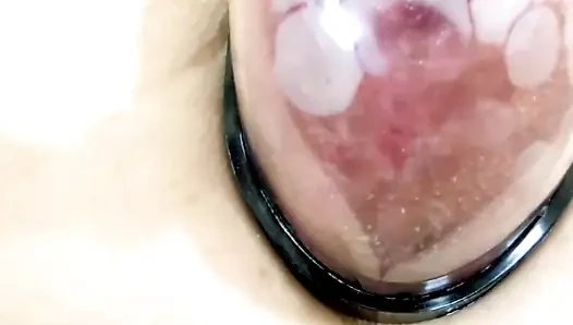 Deformasi Vagina Di Bawah Pengaruh Pompa Vakum