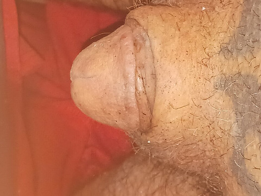 CBT BURNING COCK GLAND In Split Gland Head Into Urethra