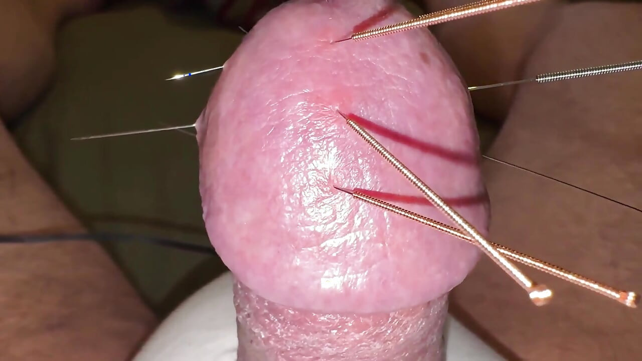 Acupuntura - Orgasmo!