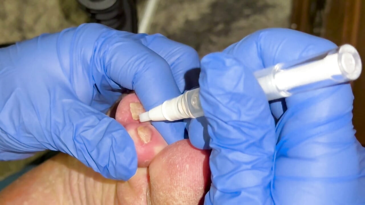 Crusty Foot Care and Worship - FTM