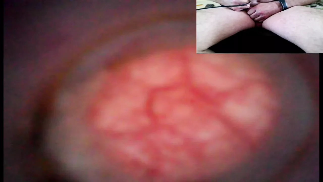 Trip down the urethra with two cameras