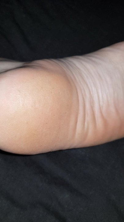 Wrinkled foot soles arches