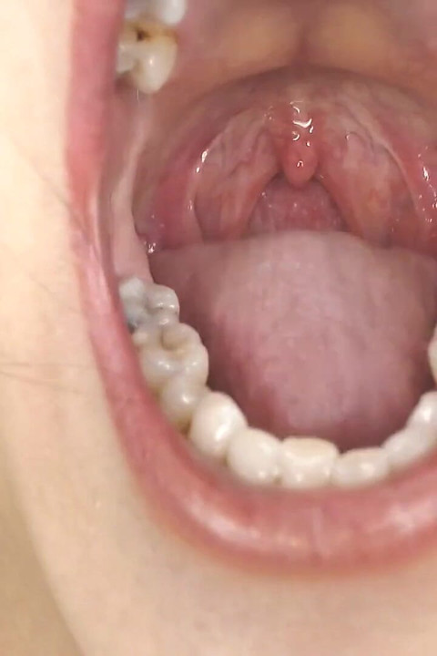 Глотка и рот слюнявы, строки Uvula, миндалины Uvula