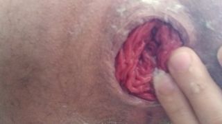 Close up self fisting with anal prolapse