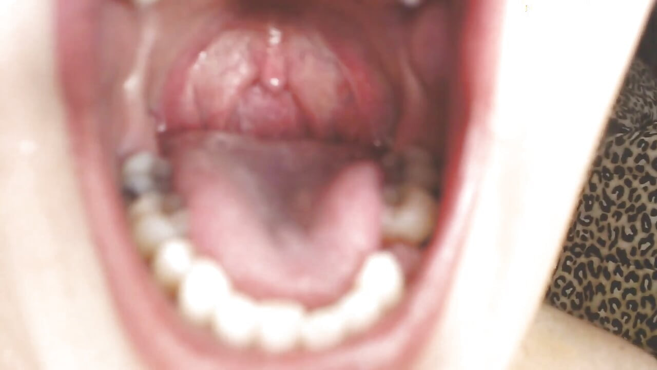 Garganta e boca cuspindo cordas Uvula Tonsils Uvula