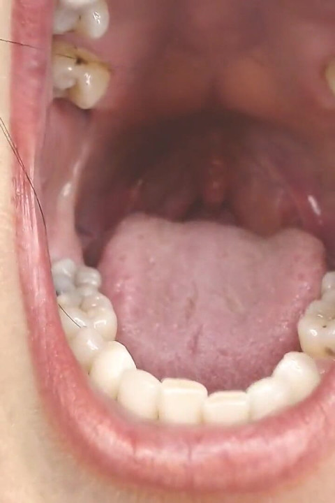 Gardło i usta rożny sznurki Uvula Tonsils Uvula