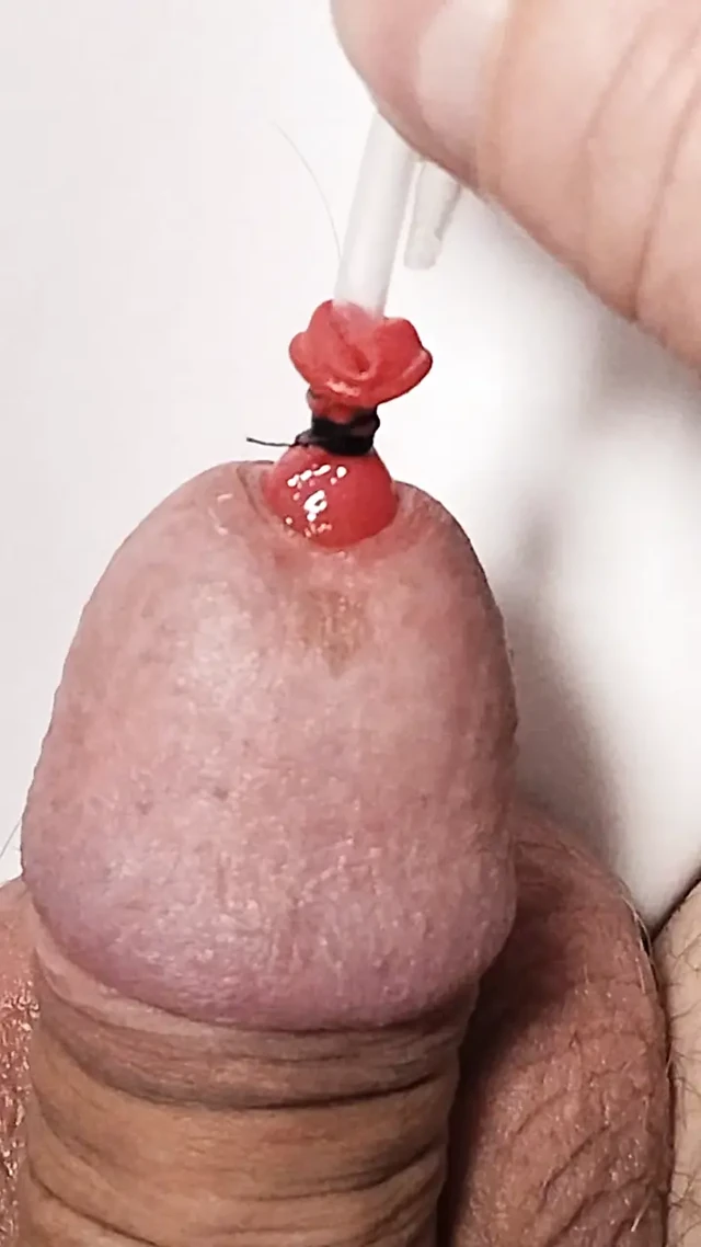 Ball in the urethra