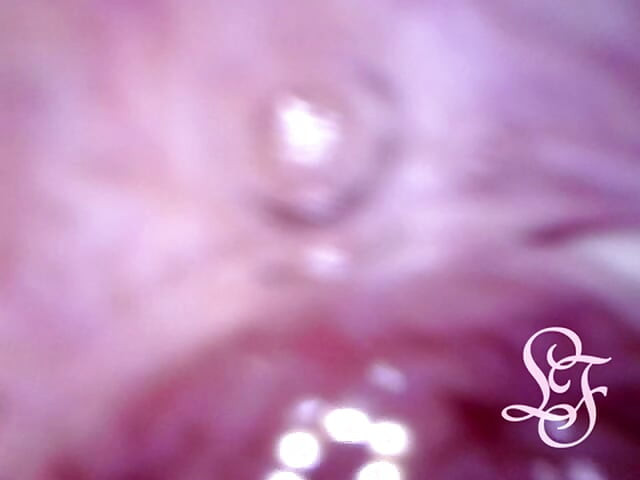 Can I fit the minicam AND a catheter inside my pee hole at the same time?